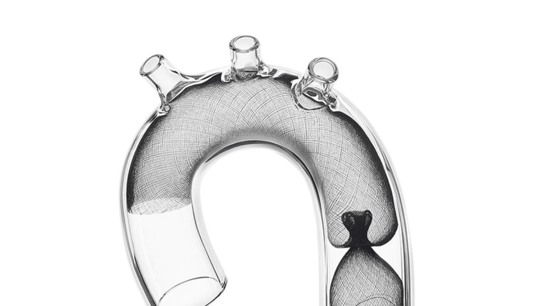 FDA Clears Emboline Emboliner for Embolic Protection During TAVR
