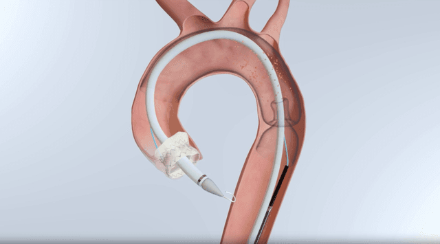 Image FDA Clears Emboline Emboliner for Embolic Protection During TAVR Image 9